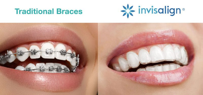 Niềng răng Invisalign mang lại tính thẩm mỹ cao hơn so với phương pháp truyền thống