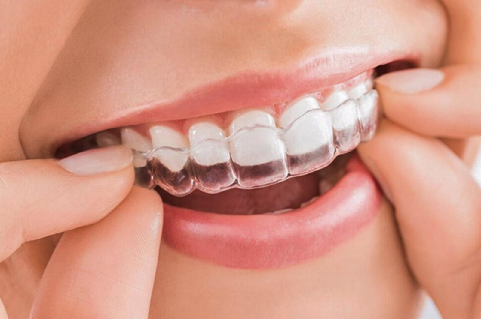 Niềng răng Invisalign giúp giảm thiểu được sự đau đớn so với phương pháp niềng răng truyền thống